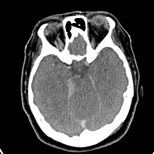 Cerebellopontine angle meningioma (Radiopaedia 35181-36714 A 6).jpg