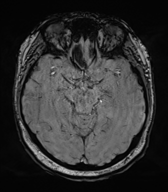 Cerebellopontine angle meningioma (Radiopaedia 48434-53348 Axial SWI 38).png