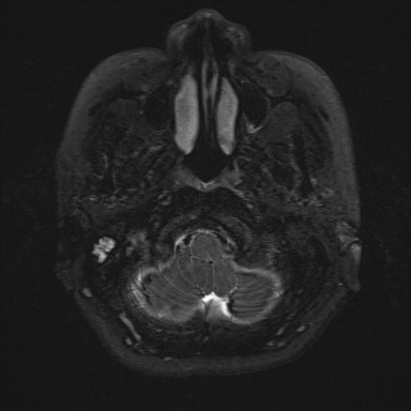 Cerebellopontine angle meningioma (Radiopaedia 53561-59591 Axial 3D volume T2 13).jpg