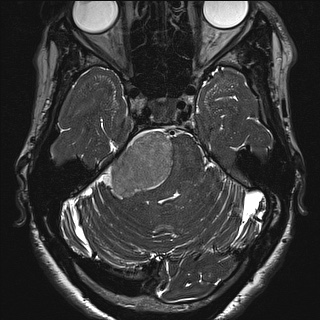 Cerebellopontine angle meningioma (Radiopaedia 72983-83680 Axial FIESTA 43).jpg