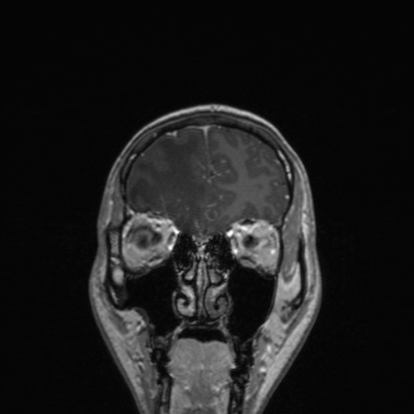 Cerebral abscess (Radiopaedia 24212-24478 Coronal T1 C+ 52).jpg
