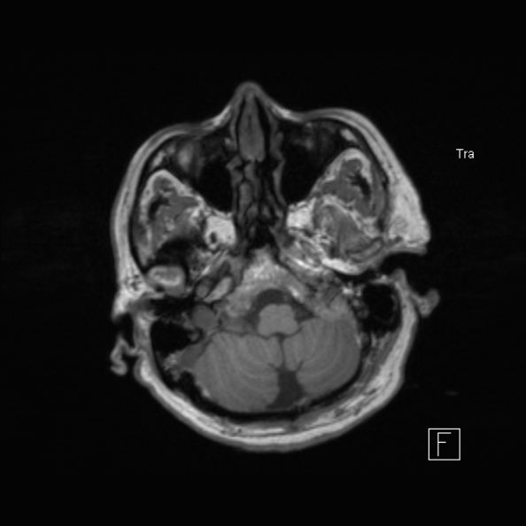 Cerebral abscess (Radiopaedia 26111-26247 Axial T1 17).jpg