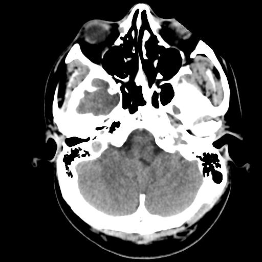 File:Cerebral abscess (Radiopaedia 29451-29919 Axial non-contrast 10).jpg