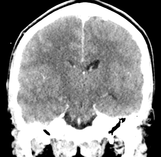 Cerebral abscess (Radiopaedia 60342-68008 Coronal C+ delayed 36).png