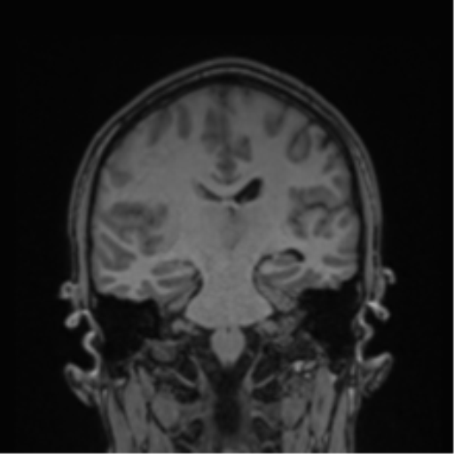 Cerebral abscess (Radiopaedia 60342-68009 Coronal T1 21).png