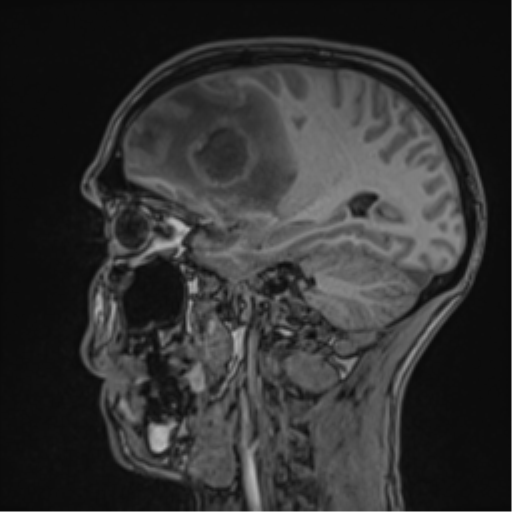 File:Cerebral abscess (Radiopaedia 60342-68009 Sagittal T1 38).png