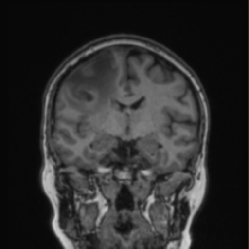 Cerebral abscess from pulmonary arteriovenous malformation (Radiopaedia 86275-102291 Coronal T1 50).png