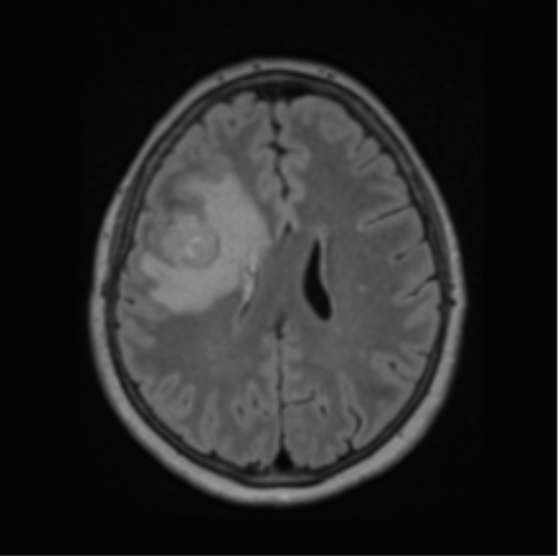 Cerebral abscess from pulmonary arteriovenous malformation (Radiopaedia 86275-102291 J 49).png