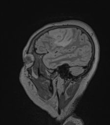 Cerebral abscess from pulmonary arteriovenous malformation (Radiopaedia 86275-102291 Sagittal FLAIR 60).png