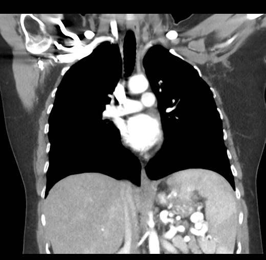 Cerebral abscess from pulmonary arteriovenous malformation (Radiopaedia 86275-102292 C 28).png