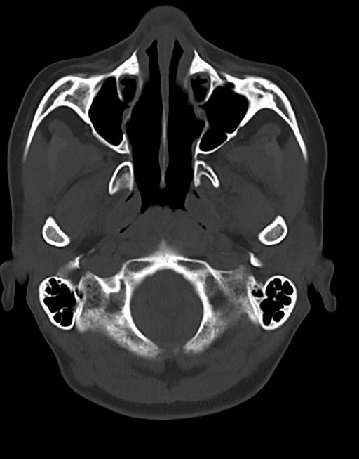 Cerebral abscesses (Radiopaedia 70458-80568 Axial bone window 12).jpg