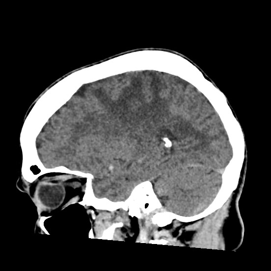 Cerebral amyloid angiopathy-related inflammation (Radiopaedia 74836-85848 C 20).jpg