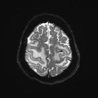 Cerebral amyloid angiopathy-related inflammation (Radiopaedia 74836-85849 Axial DWI 24).jpg