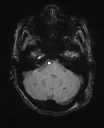 File:Cerebral amyloid angiopathy-related inflammation (Radiopaedia 74836-85849 Axial SWI 17).jpg