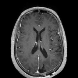 Cerebral amyloid angiopathy (Radiopaedia 29129-29518 Axial T1 C+ 88).jpg