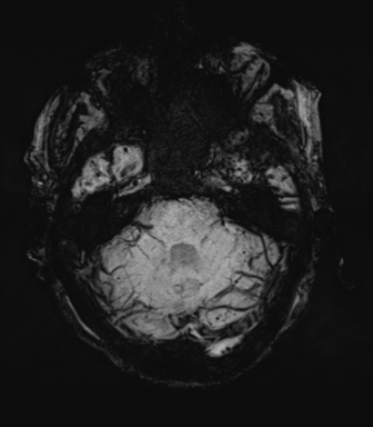 File:Cerebral amyloid angiopathy (Radiopaedia 46082-50433 Axial SWI MIP 18).png