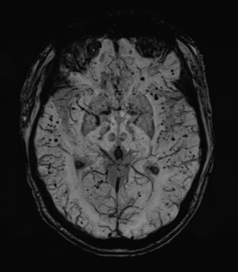 Cerebral amyloid angiopathy (Radiopaedia 46082-50433 Axial SWI MIP 36).png