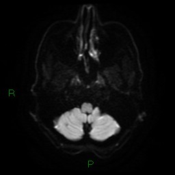 File:Cerebral amyloid angiopathy (Radiopaedia 77506-89664 Axial DWI 5).jpg