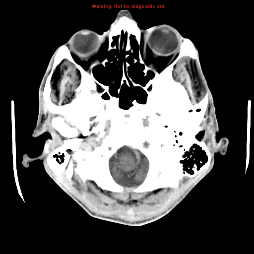 File:Cerebral and orbital tuberculomas (Radiopaedia 13308-13310 B 5).jpg