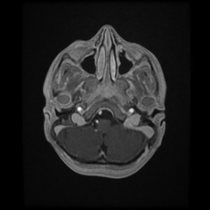 Cerebral and spinal tuberculosis (Radiopaedia 90489-107837 Axial T1 C+ 45).jpg