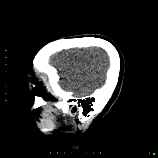 Cerebral arteriovenous malformation (AVM) (Radiopaedia 78162-90706 A 67).jpg
