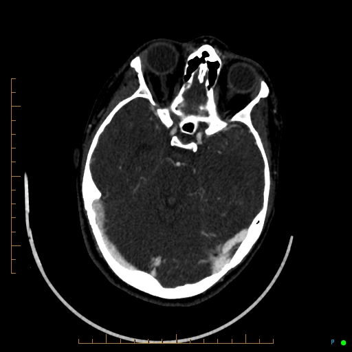 Cerebral arteriovenous malformation (AVM) (Radiopaedia 78162-90706 Axial CTA 105).jpg