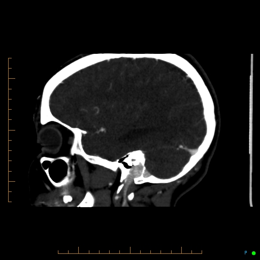 File:Cerebral arteriovenous malformation (AVM) (Radiopaedia 78162-90706 Sagittal CTA 58).jpg