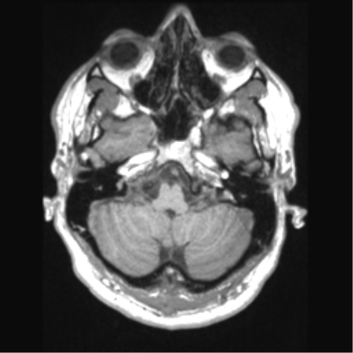 Cerebral arteriovenous malformation (Radiopaedia 39259-41506 Axial T1 17).png