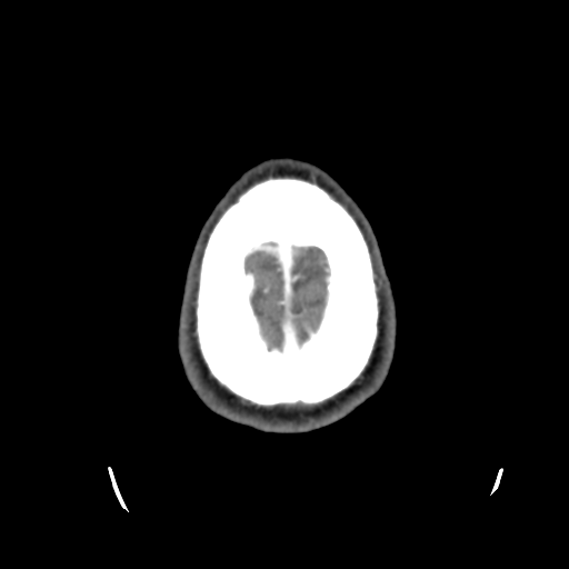 Cerebral arteriovenous malformation (Radiopaedia 55798-62371 B 49).png