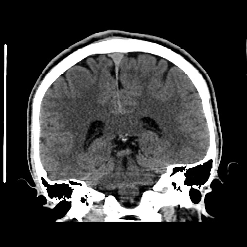 Cerebral arteriovenous malformation (Radiopaedia 61964-70028 Coronal non-contrast 39).jpg