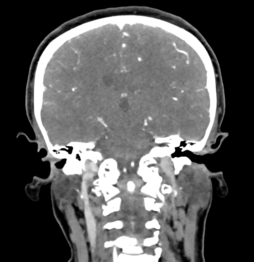 Cerebral arteriovenous malformation (Radiopaedia 73830-84645 C 58).jpg