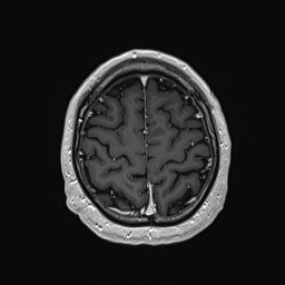 Cerebral arteriovenous malformation (Radiopaedia 84015-99245 Axial T1 C+ 129).jpg