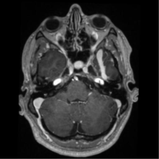 File:Cerebral arteriovenous malformation - huge (Radiopaedia 35734-37272 Axial T1 C+ 15).png