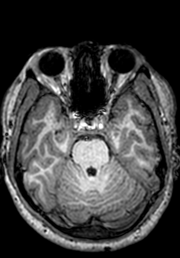 Cerebral arteriovenous malformation at posterior body of corpus callosum (Radiopaedia 74111-84925 Axial T1 213).jpg