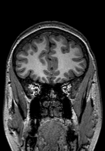 File:Cerebral arteriovenous malformation at posterior body of corpus callosum (Radiopaedia 74111-84925 Coronal T1 60).jpg