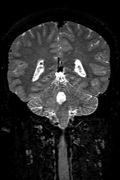 Cerebral arteriovenous malformation at posterior body of corpus callosum (Radiopaedia 74111-84925 Coronal T2 119).jpg