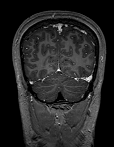 Cerebral arteriovenous malformation at posterior body of corpus callosum (Radiopaedia 74111-84925 K 310).jpg
