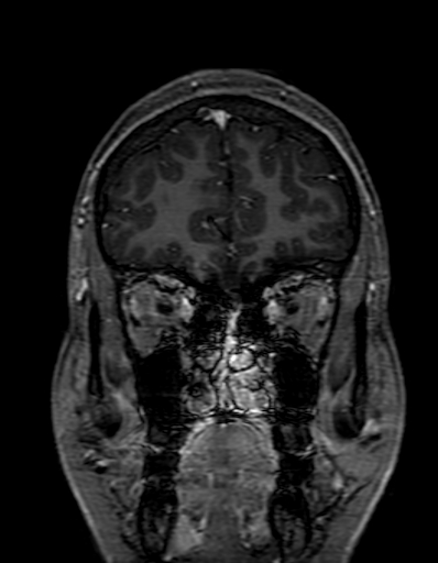 Cerebral arteriovenous malformation at posterior body of corpus callosum (Radiopaedia 74111-84925 K 56).jpg