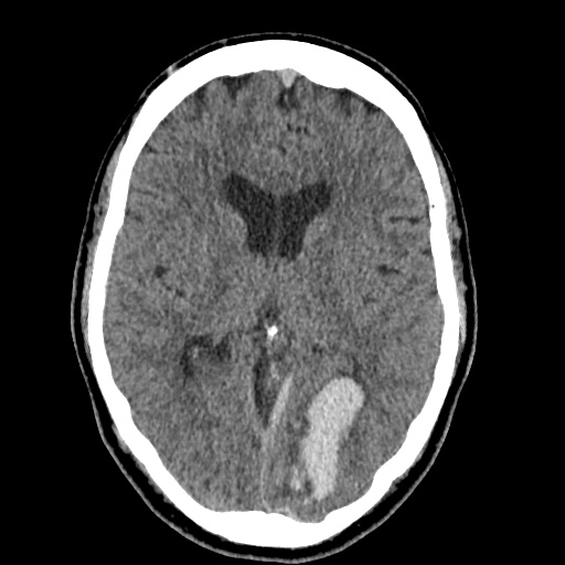 Cerebral arteriovenous malformation with lobar hemorrhage (Radiopaedia 35598-37117 Axial non-contrast 27).jpg