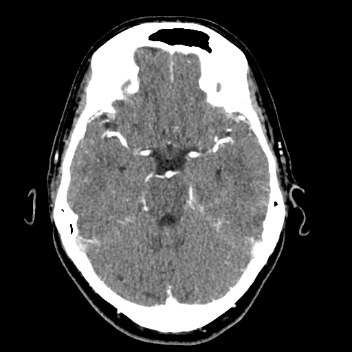 Cerebral arteriovenous malformation with lobar hemorrhage (Radiopaedia 35598-57216 A 21).jpg