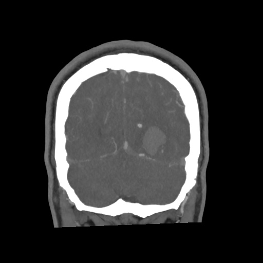 Cerebral arteriovenous malformation with lobar hemorrhage (Radiopaedia 35598-57216 C 77).jpg