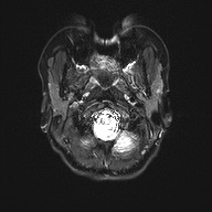 File:Cerebral cavernous venous malformation (Radiopaedia 70008-80021 Axial DWI 2).jpg