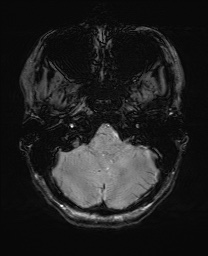Cerebral cavernous venous malformation (Radiopaedia 70008-80021 I 11).jpg