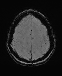 Cerebral cavernous venous malformation (Radiopaedia 70008-80021 I 60).jpg