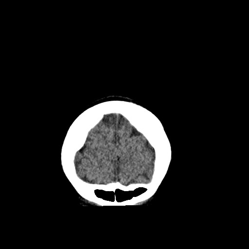 Cerebral cavernous venous malformation (Radiopaedia 70008-80022 non-contrast 6).jpg