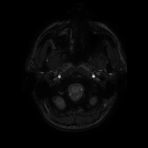Cerebral cavernous venous malformation (Zabramski type II) (Radiopaedia 85511-101198 Axial SWI 12).jpg