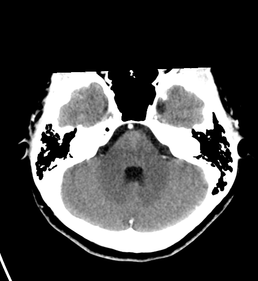 File:Cerebral cavernous venous malformations (Radiopaedia 48117-52945 Axial C+ delayed 11).png