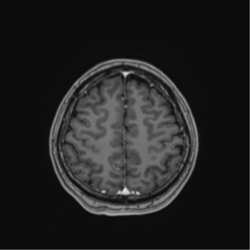 File:Cerebral cavernous venous malformations (Radiopaedia 48117-52946 Axial T1 C+ 50).png