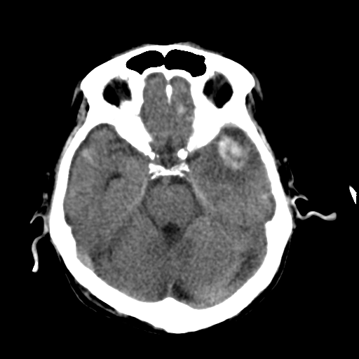 File:Cerebral contusions, subarachnoid hemorrhage and subdural hygromas (Radiopaedia 55399-61827 Axial non-contrast 13).png
