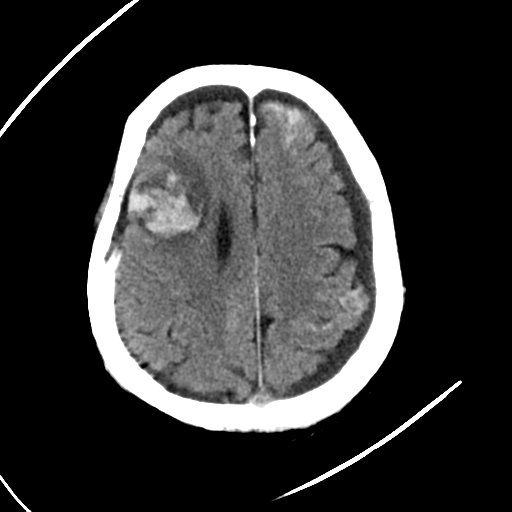 File:Cerebral contusions, subarachnoid hemorrhage and subdural hygromas (Radiopaedia 55399-61830 Axial non-contrast 22).png